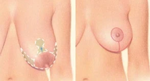 Breast Lift Example - 5