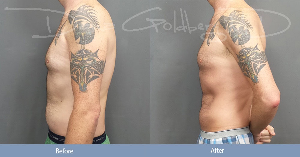 Men's Liposuction Before & After Photos