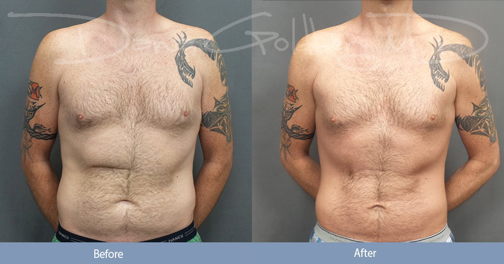 Men's Liposuction Before & After Photos