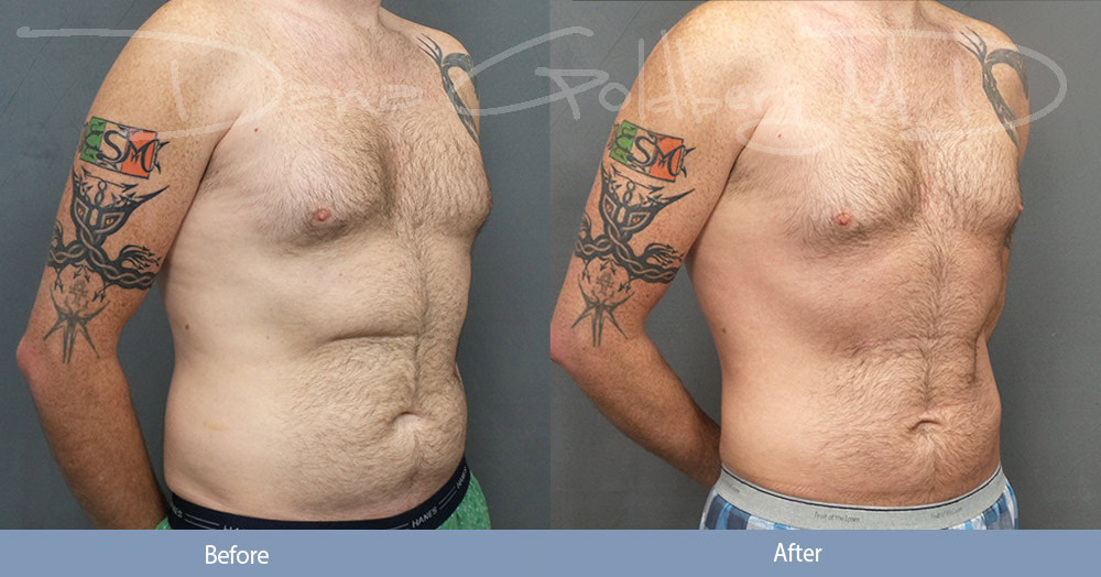 Men's Liposuction Before & After Photos
