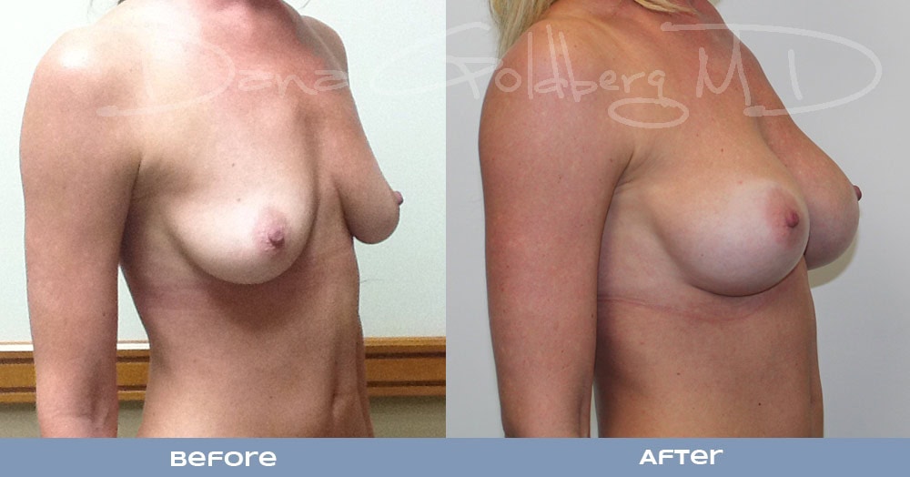 Breast Augmentation Before & After Photos - Angle