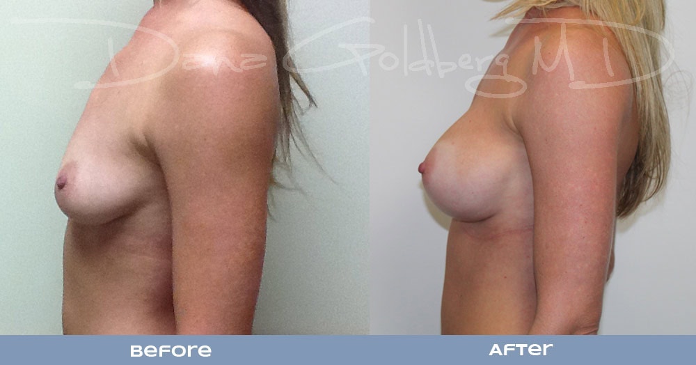 Breast Augmentation Before & After Photos - Side