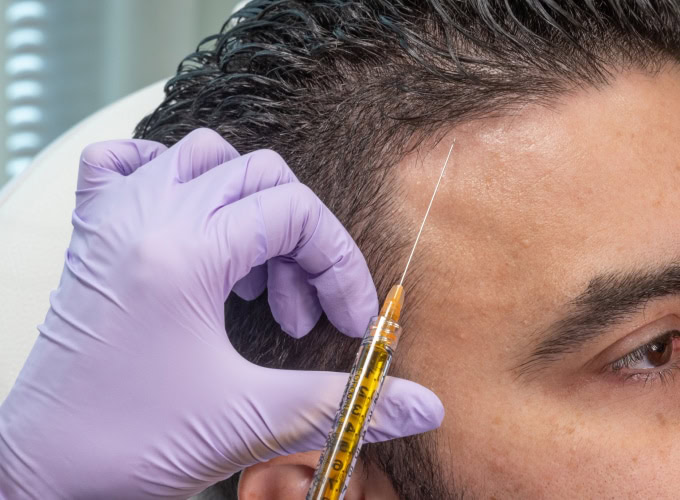 prp hair restoration